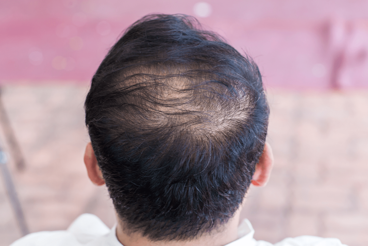 Hair loss restoration